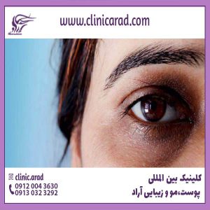 سیاهی دور چشم نشانه چه بیماری است؟